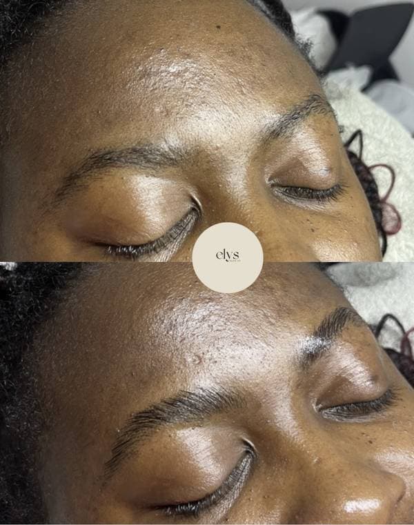 Vorher Nachher – Wimpern Lifting